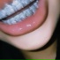 ilytr3