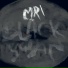 MRI